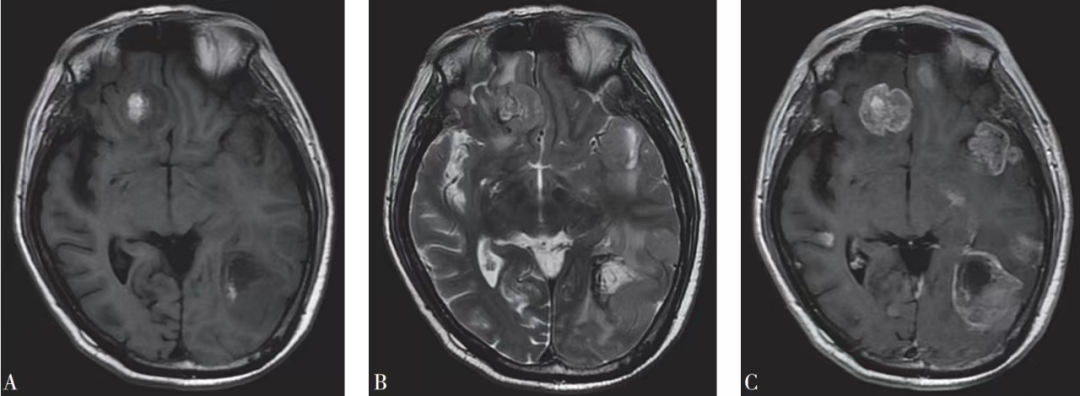 EndoScell?術中手持顯微鏡助力腦轉(zhuǎn)移瘤細胞級精準手術，最大化安全切除(圖4)
