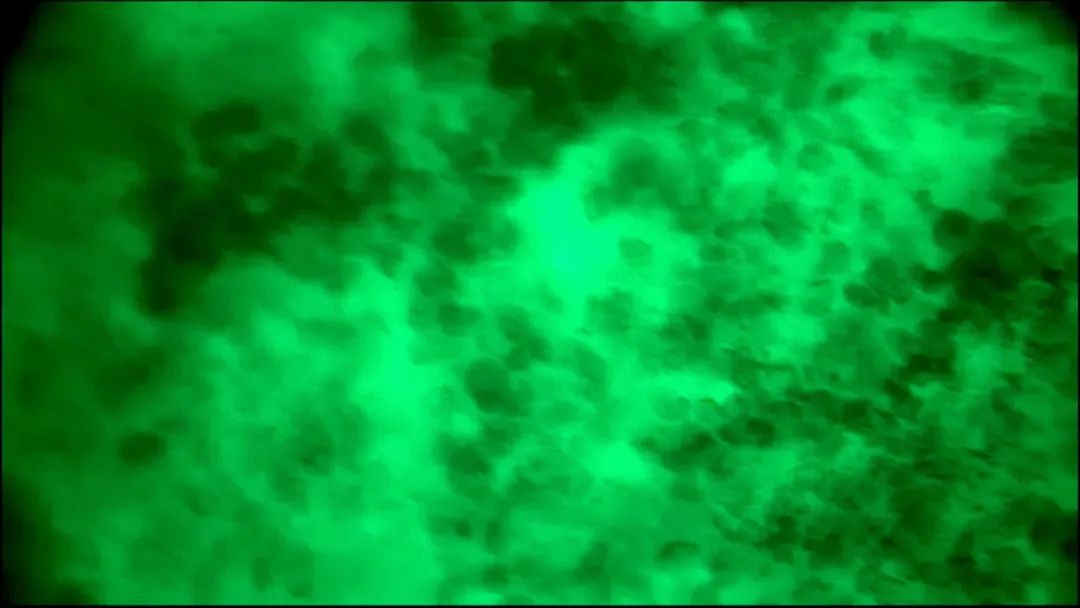 EndoScell?術中手持顯微鏡助力腦轉(zhuǎn)移瘤細胞級精準手術，最大化安全切除(圖5)