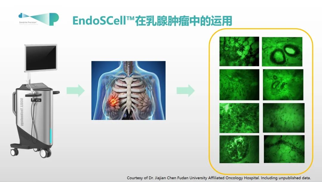 保乳手術(shù)和乳房重建術(shù)的最新強助力：術(shù)中手持顯微鏡EndoSCell?(圖6)