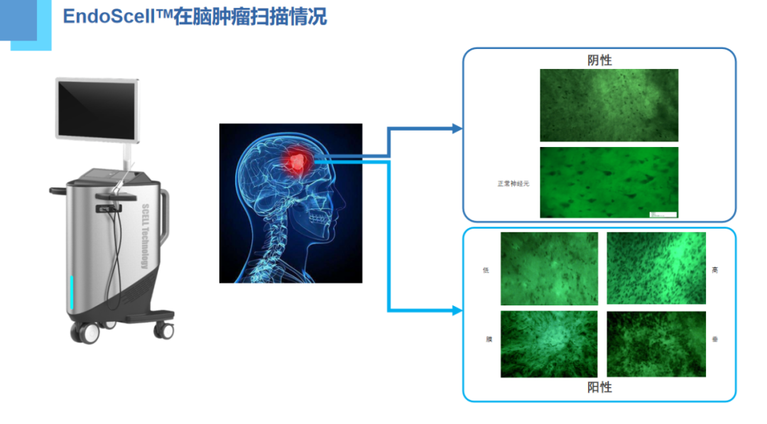 術(shù)中手持顯微鏡EndoSCell?（安刀）亮相2024天壇腦網(wǎng)絡(luò)神經(jīng)外科年會(huì)，細(xì)胞級(jí)精準(zhǔn)手術(shù)方案成為焦點(diǎn)(圖4)