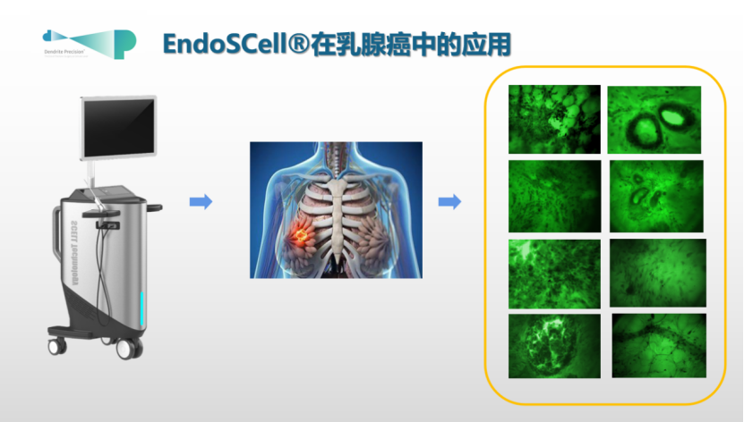 天津國際乳腺癌大會專家銳評：EndoSCell?細胞級精準手術(shù)有助提高保乳率(圖3)